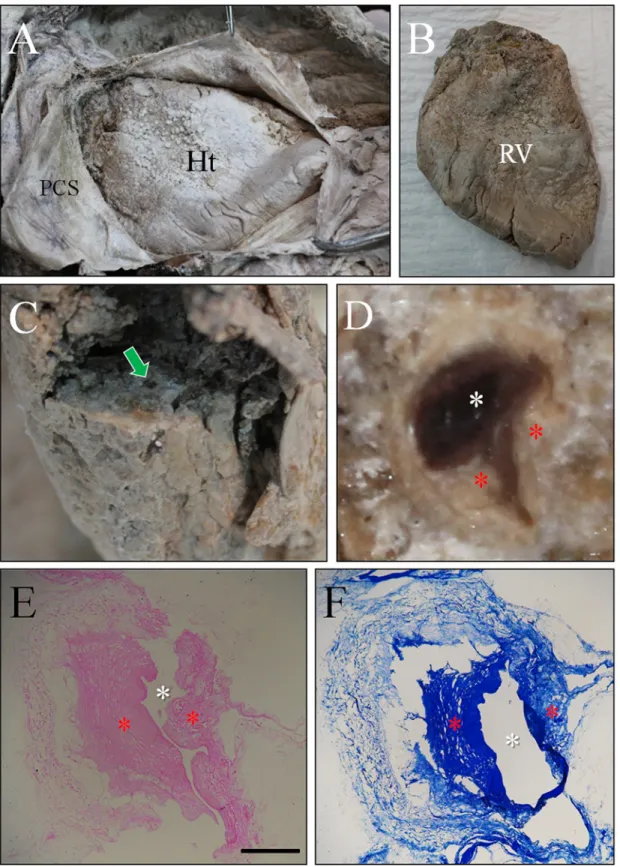 Fig 6. Gross appearance of heart and its coronary arterial sclerosis with histological findings