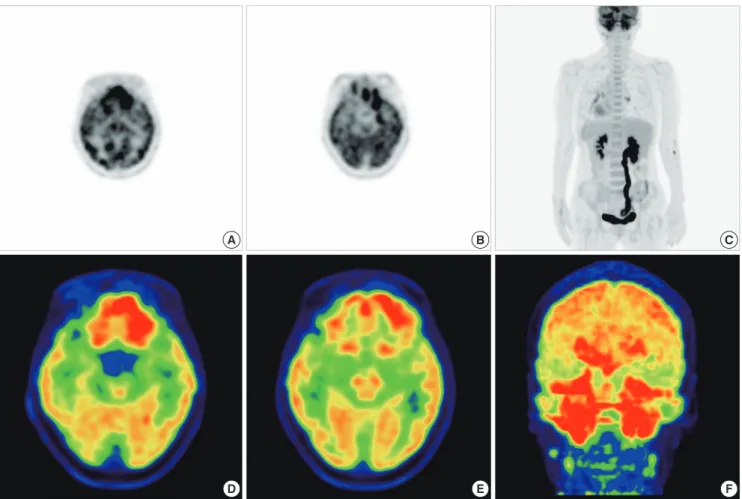 Fig. 3.  18 F-FDG PET. (A to C) Prominent hypermetabolism in bilateral tonsil area of nasopharynx and multiple lymph nodes of neck level II and III were shown