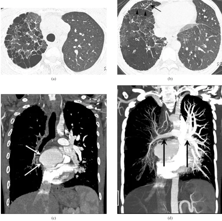 Figure 1. Asymptomatic 23-year-old male with unilateral isolated pulmonary vein atresia