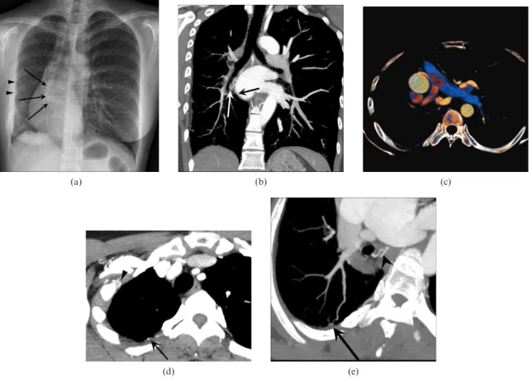 Figure 2. Asymptomatic 39-year-old female with unilateral isolated pulmonary vein atresia