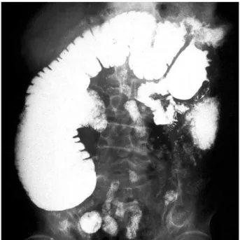 Fig. 1. Small bowel series revealed markedly dilated intestinal loops with multiple narrowings