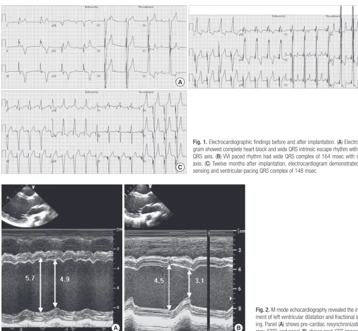 Fig. 1. Electrocardiographic findings before and after implantation. (A) Electrocardio­ gram showed complete heart block and wide QRS intrinsic escape rhythm with normal  QRS axis