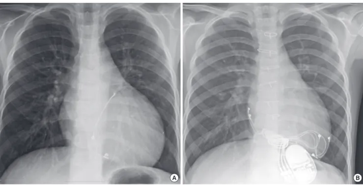 Fig. 4. Chest radiography showed the improvement of cardiomegaly. Panel (A) shows pre­cardiac resynchronization therapy (CRT) and panel (B) shows post­CRT images.