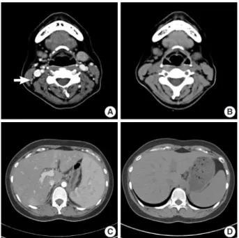 Fig. 5. Histologic finding of the liver biopsy. The liver biopsy shows  granulomatous inflammation, compatible with dapsone-induced  hepatitis