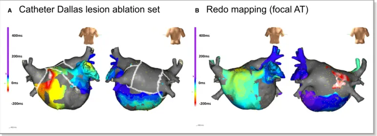 Figure 1. A, Catheter Dallas lesion ablation set with electroanatomical activation map acquired during stable right atrial pacing revealing LAPW isolation without AL block