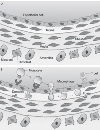Figure 2. The progress of atherosclerotic lesions. (A) Progression of the  lesion is accompanied by proliferation of smooth muscle cells (SMCs) and  medium derived SMCs by migration of SMC from the medium to the intima