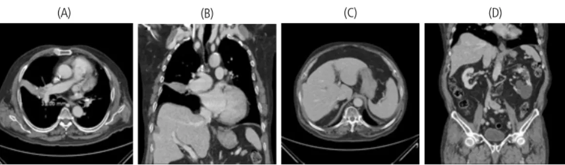 Figure 1. The chest computed tomography(CT) on November 2014 showed about 3.1cm sized lung mass in right middle  lobe(RML) with lymph nodes metastases(A, B)