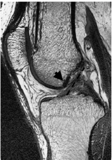 Figure  6.  MR  image  of  the  orientation  of  the  ACL  in  a  human  subject  in  a  relaxed,  fully  extended position
