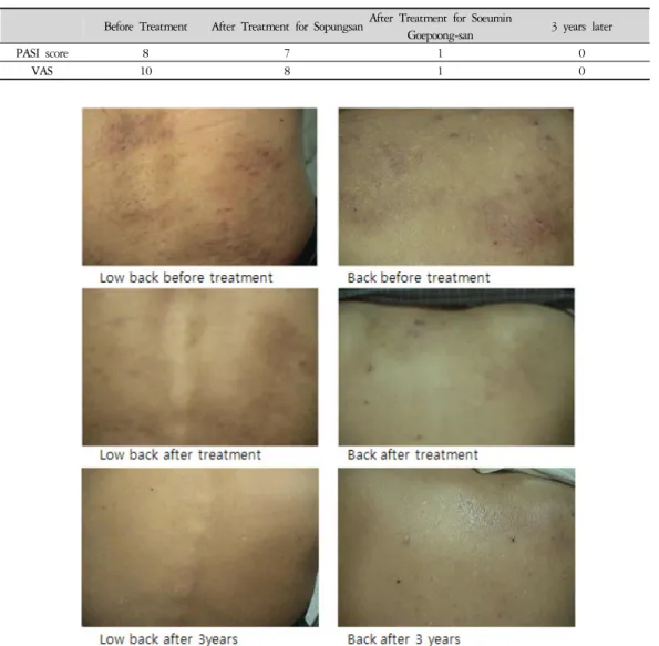 Table 3. Severity Score of Psoriasis 