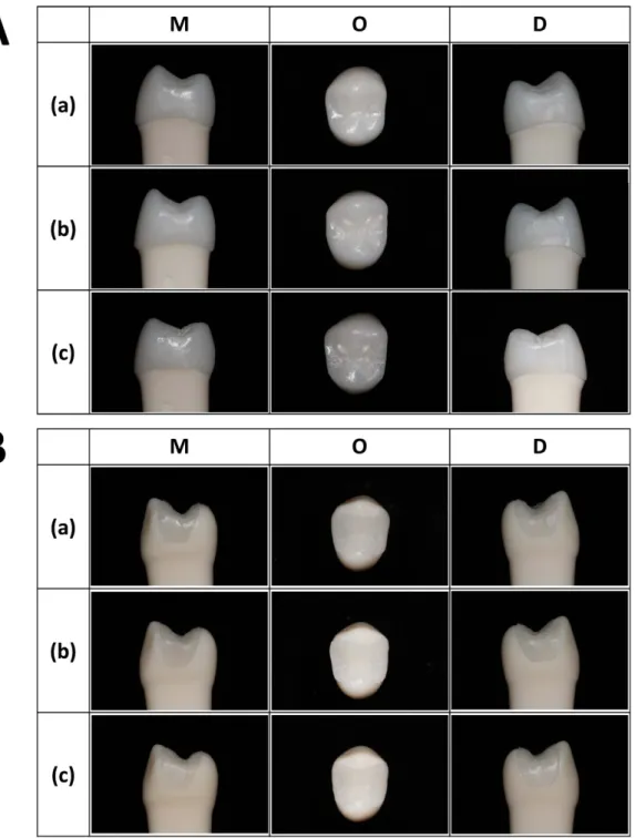 Figure 5.  Mesial, Occlusal, and Distal view of final (A) crown and (B) inlay restorations on the typodont 