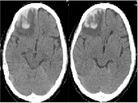 Figure  1.  The  front  &amp;  lateral  side  of  face Figure  2.  Brain  CT  (2011.04.19) 3) 운동검사 (Motor Examination)11