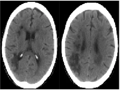Figure  3.  The  front  &amp;  lateral  side  of  face Figure  4.  Brain  CT  (2011.04.18)