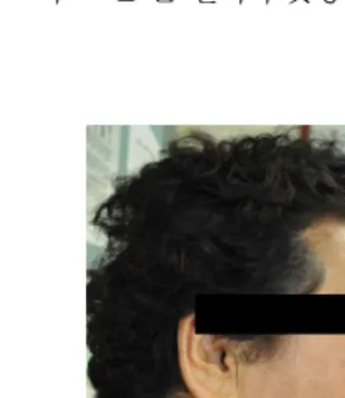 Fig.  4.  Frontal  view  of  face  Fig.  5.  Lateral  view  of  face③ 전반적 경과 : 속쓰림이 새벽에 약간 있었음.천면 양상