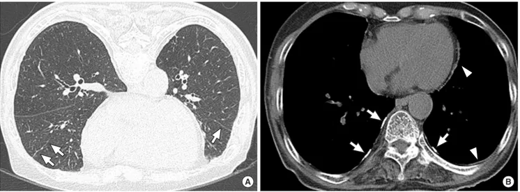 Fig. 2. CT images of a 72-yr-old man with 72 yr residence history. (A) Prone positioned HRCT scan shows subpleural dot-like or branching opacities (arrows), and intralobular  interstitial thickening (arrowheads)