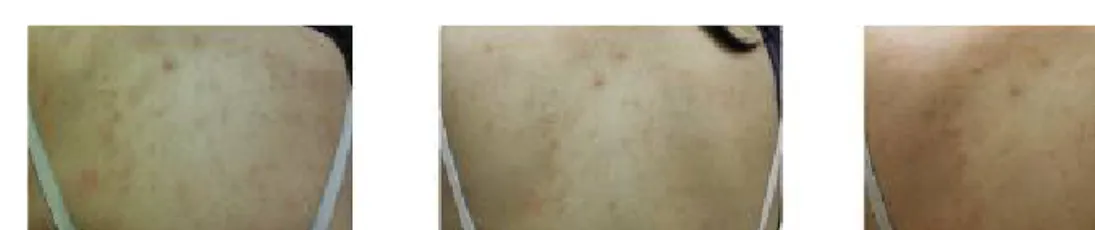 Fig.  6.  Progress  of  atopic  dermatitis  on  abdomen.