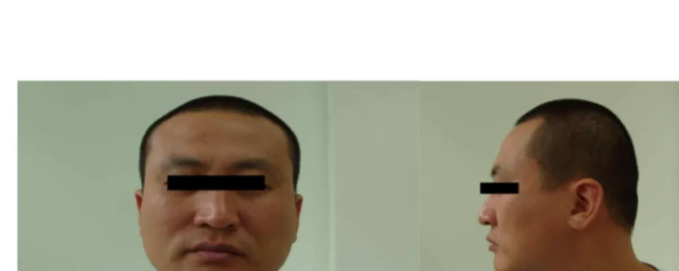 Fig.  1.  Patient's  anterior  view             Fig.  2.  Patient's  lateral  view9.  초진소견① 食慾 및 消化평소에는 식욕 양호하고 소화에도 큰 문제 없었으나 6월 3일경부터 식욕이 떨어졌고, 현재는惡心이 심하여 거의 식사하지 못함.② 大便1회/1일 정상변 보다가 작년부터 2회/1일, 비교적 정상변 보는 상태.③ 小便평소 정상 상태였으나, 6월 5일경부터 소변색이갈색임.④ 睡眠수면 상태는