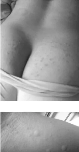 Fig.  3.  View  of  Urticaria's  Symptoms 4)  초진소견 ①  睡眠 :  평소 당구장 운영으로 수면시간 이 규칙적이지는 않으나 잠들면 잘 자는  편