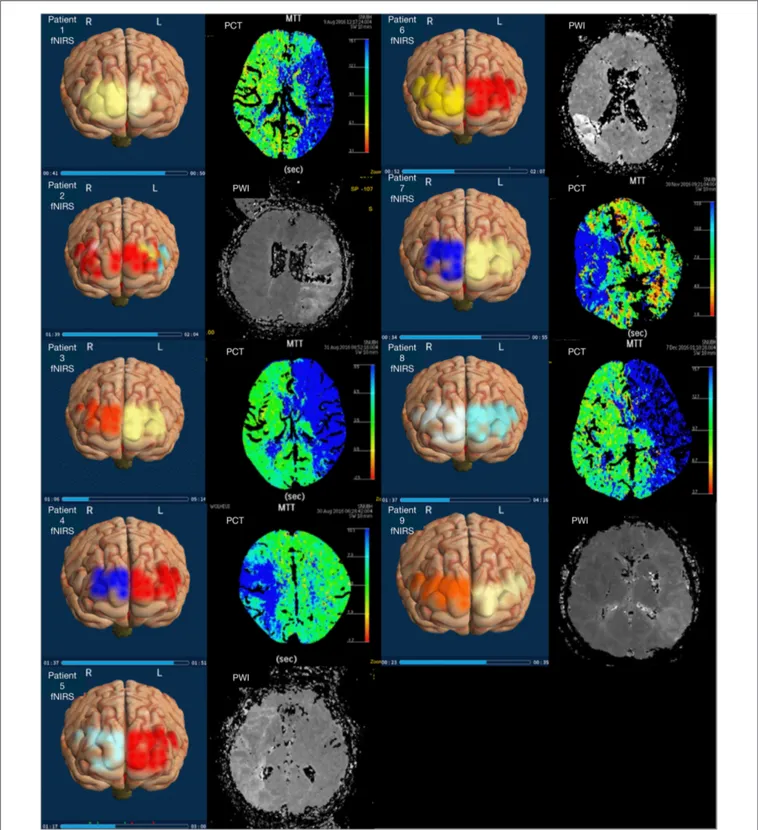 FIGURE 3 | Images from fNIRS vs. PCT or PWI. This figure shows the comparison of fNIRS images and PCT or PWI images from MCA infarction patients