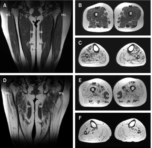 Figure 3.  T1-weighted magnetic resonance images (MRI) of the thighs and legs of a patient (V-30) with 15 years 