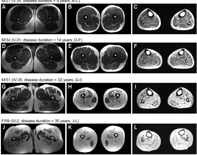 Figure 4.  T1-weighted MRI of upper and mid thighs, and legs according to disease progress, i.e., less than 20 years disease duration 
