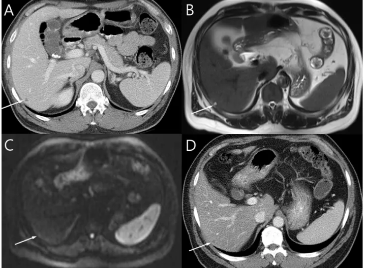 Fig 2. A 56-year-old male diagnosed with distal rectal cancer. (A) A 0.6 cm low attenuating nodule is noted in segment six of the liver on CT