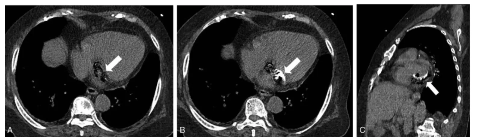 Figure 1. Noncontrast-enhanced axial (A and B) and short-axis cardiac (C) CT images revealing abnormal air bubbles surrounding the calciﬁed mitral valve annulus (arrows)