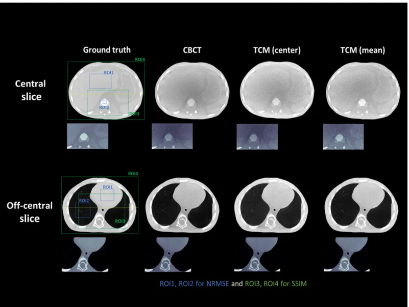Table 1 shows reconstructed CT images using the TCM method had comparable NRMSE