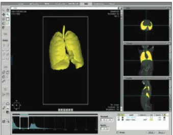 Figure 2:  Postoperative measurement of total lung volume using  3-dimensional (3D) computed tomography (CT)