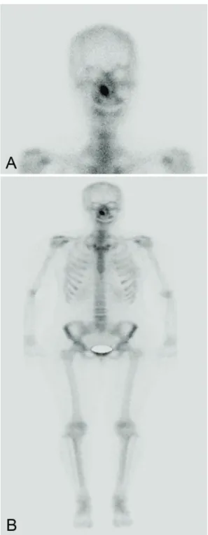 Figure 2. Preoperative bone scan. Whole body bone  scan (A and B) shows hot uptake in the right inferior  turbinate in otherwise normal study.