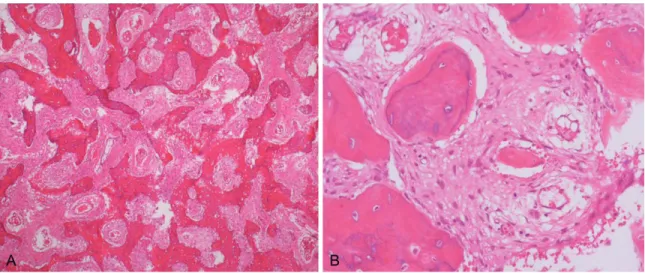 Figure 3.  Histologic  examination.  Microscopic  finding  demonstrates  woven  bone  formation,  surrounding  fibrous  stroma without osteoblastic rimming and irregular Chinese character-like bony trabeculae