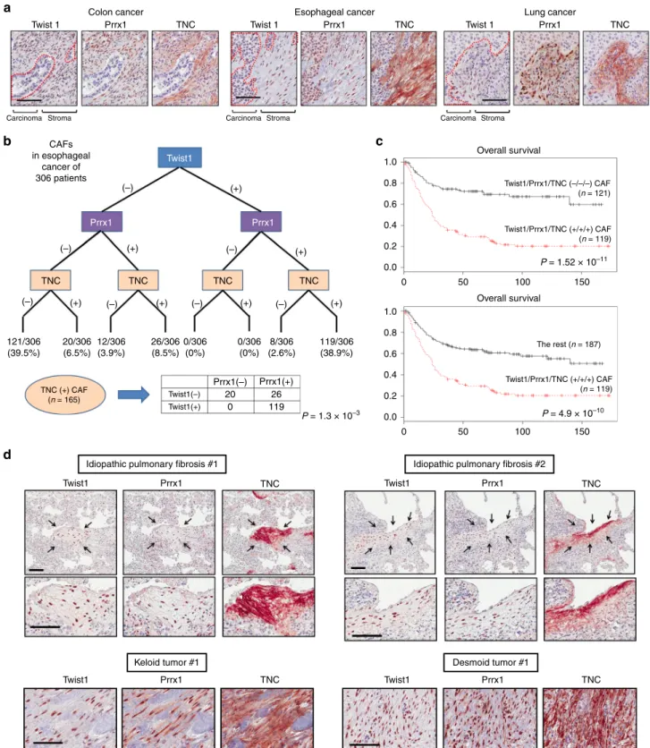 Fig. 8 The coexpression of Twist1, Prrx1, and TNC is frequently found in cancer-associated ﬁbroblasts and pathologic ﬁbrosis