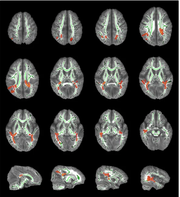 Figure 4.  TBSS results. Comparisons of the mean FA maps of preterm infants at 18–22 months of corrected age  between the SHP-2 variant and control groups