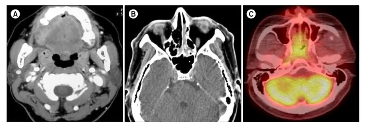 Fig. 1.  Computed tomography (CT) findings of 56-year-old woman with primary gingival involvement (A) and 48-year-old man with nasal cavity and naso-oropharynx involvement by myeloid sarcoma (B, C)
