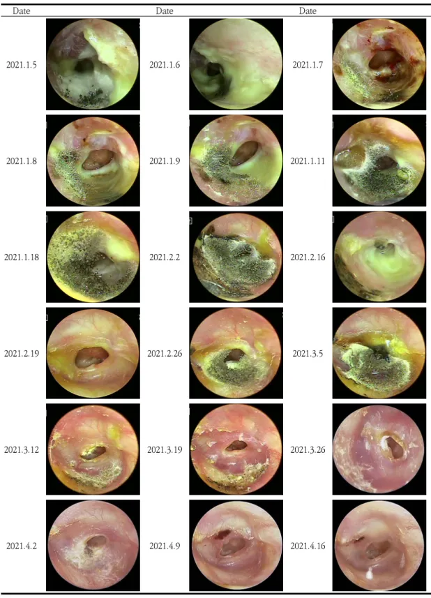 Fig.  2.  Finding  of  Otoscope(Left  Ear)