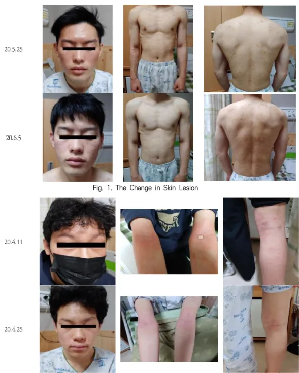 Fig.  1.  The  Change  in  Skin  Lesion