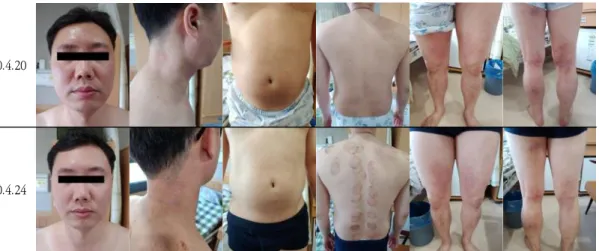 Fig.  4.  The  Change  in  Skin  Lesion  during  2nd  Admission