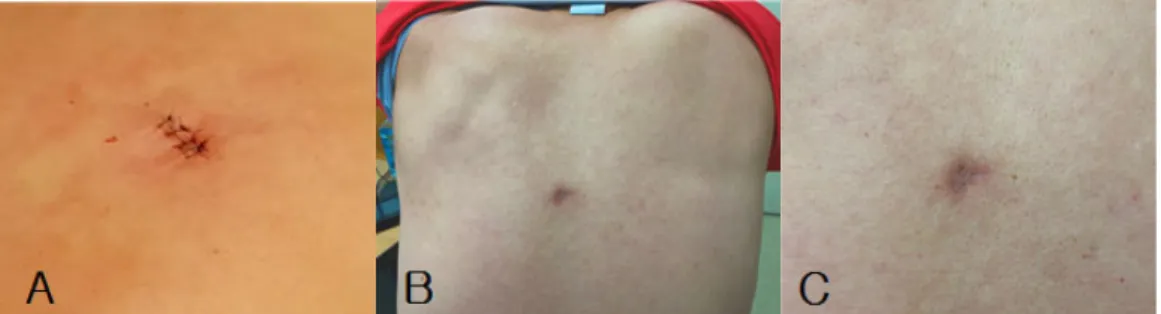 Fig. 4. A.  Closed  type  of  epidermal  cyst  on  the  upper  back,  January  6th,  2020