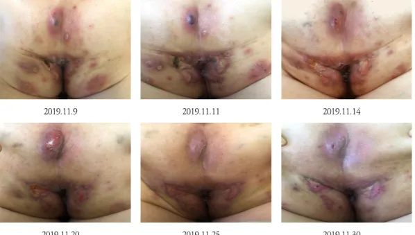Fig.  3.  Changes  of  Skin  Lesion  During  Treatment  (Admission  1)