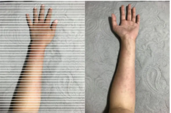 Fig.  1.  2018.6.3.  Left  Arm. 