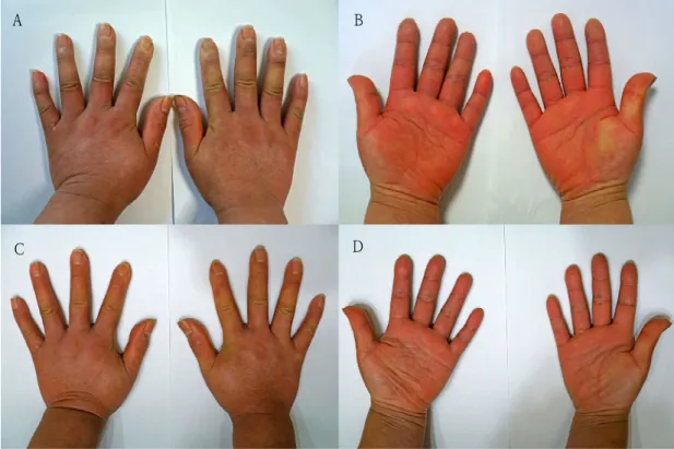 Fig.  1.    Change  of  Hand  Skin  before  and  after  Treatment