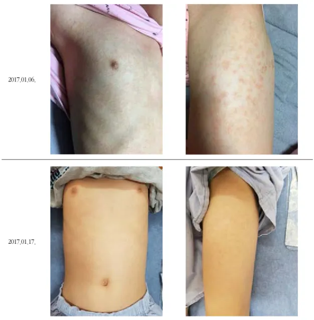 Fig. 2. Before and after treatment of case 14.  현병력
