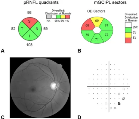 Fig 1. Representative case of anti-SSB positive patient (right eye of 51 year-old female) who showed abnormally reduced thickness of the peripapillary retinal nerve fiber layer (pRNFL) and macular ganglion cell –inner plexiform layer (mGCIPL)