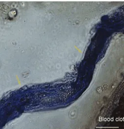 Figure 5: The Bonghan duct and blood clot stained using Cr-Hx. The Bonghan duct (arrows) in the venous sinuses of a rat brain protruded from a blood clot is stained blue by Cr-Hx under a light microscope
