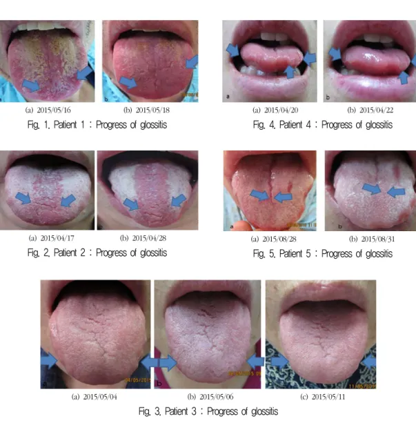 Fig. 1. Patient 1 : Progress of glossitis