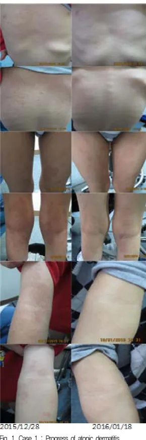 Fig. 2. Case 2 : Progress of atopic dermatitis