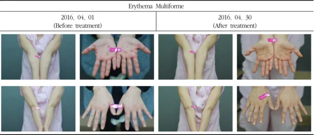 Fig. 2. Pictures of skin lesion - case 2