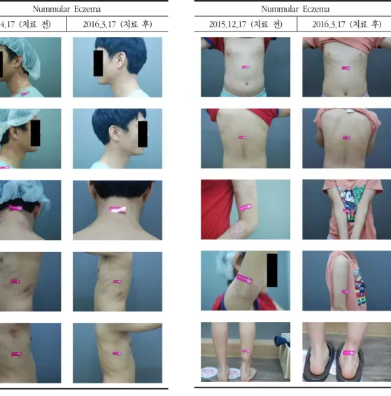 Fig. 6. Pictures of skin lesion – case 3