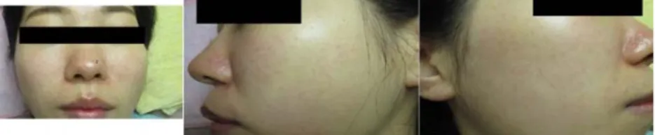 Fig. 6. 5 Months after Treatment, Hyperpigmentation of 13th Treatment Site Disappeared.