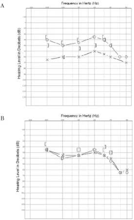 Fig. 3. Pure tone audiometry progress of case 2 
