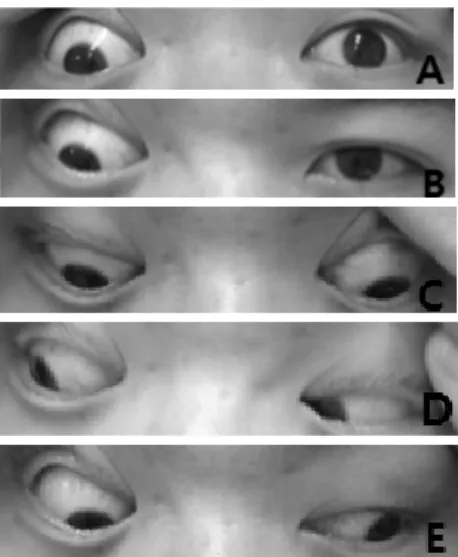 Fig. 2. The  photographs  of  the  extraocular  movements  of patient. 
